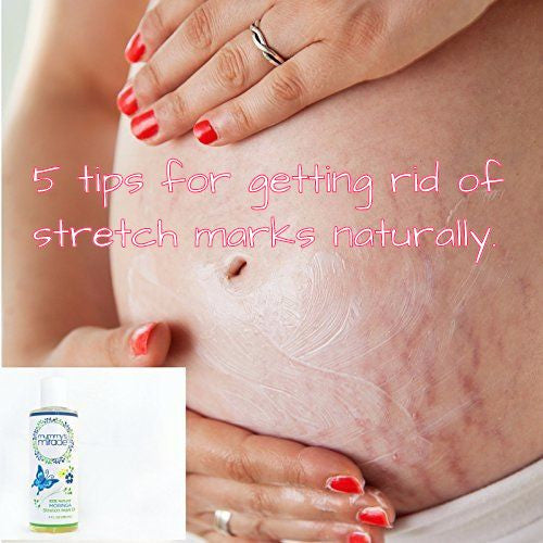 5 Tips for Getting Rid of Stretch Marks Naturally